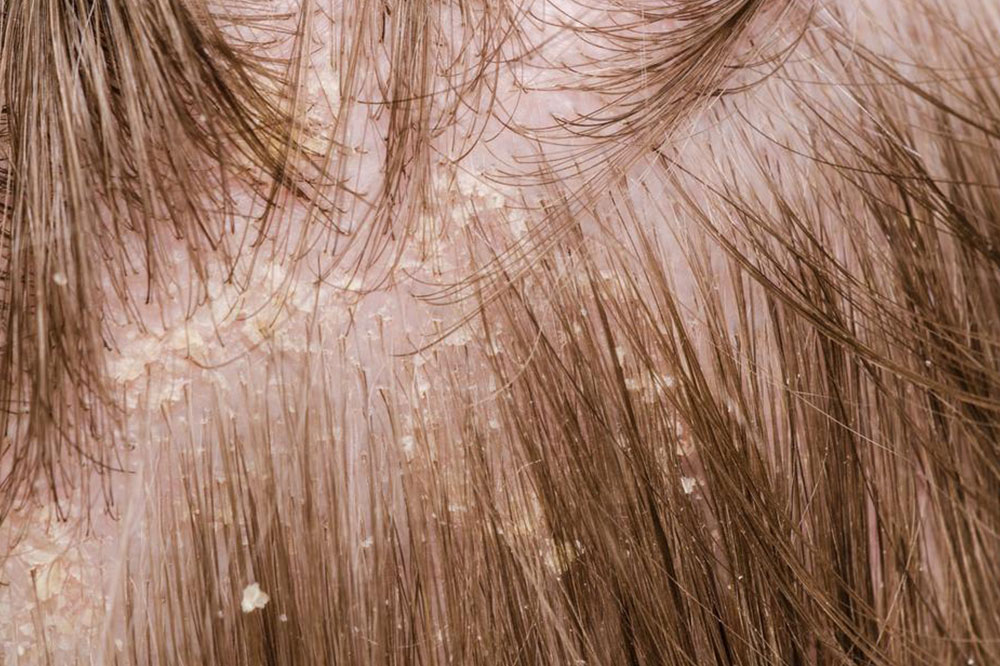 Get Rid of Dandruff With These Reliable Products