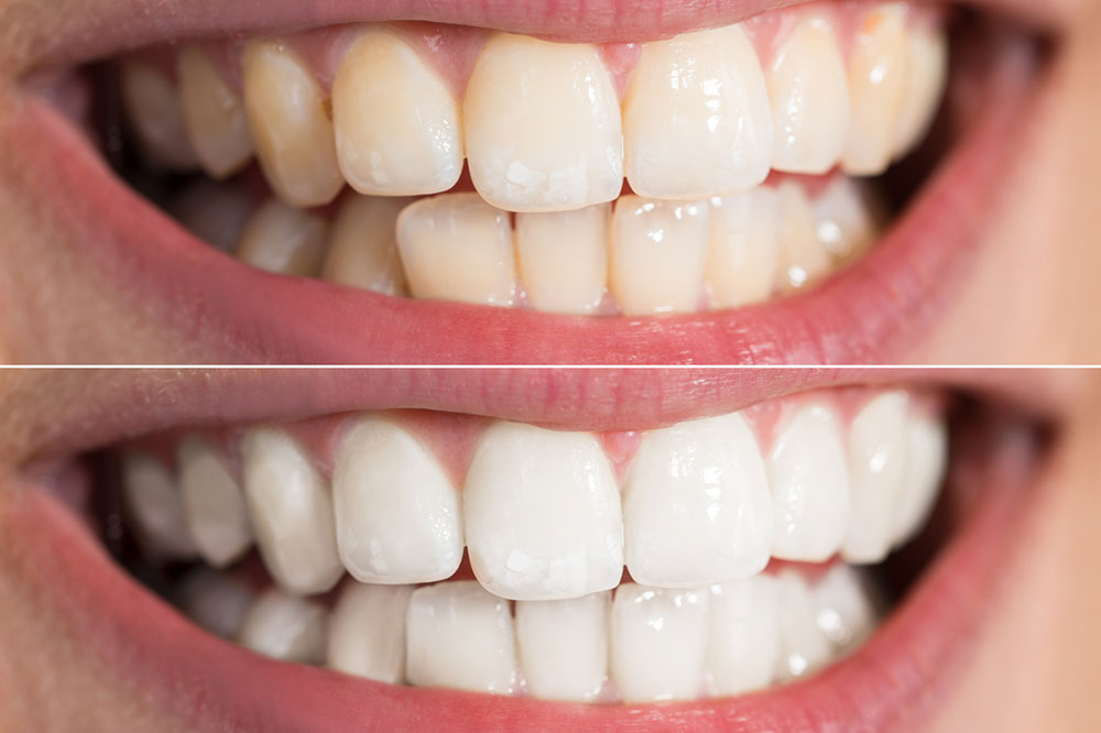 Highly Effective Teeth Whitening Products